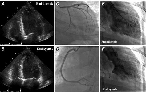 severe hypokinesia
